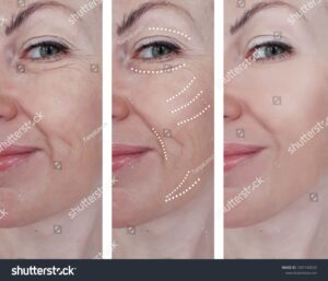 Expert Botox injections in London for a youthful appearance