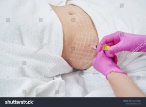 Fat disovling injections
