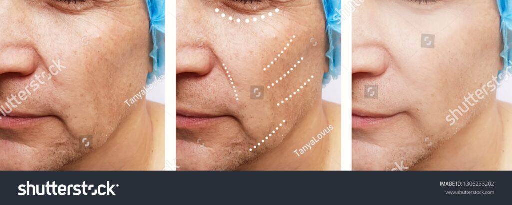 Professional Botox injections in London to reduce fine lines