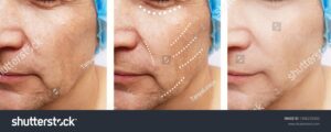 Professional Botox injections in London to reduce fine lines Professional Botox injections in London to reduce fine lines