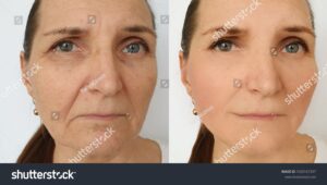 anti-wrinkle anti-wrinkle