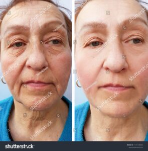 anti-wrinkle treatments to help prevent & reduce the formation of wrinkles