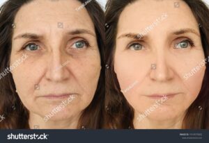 before and after anti wrinkles
