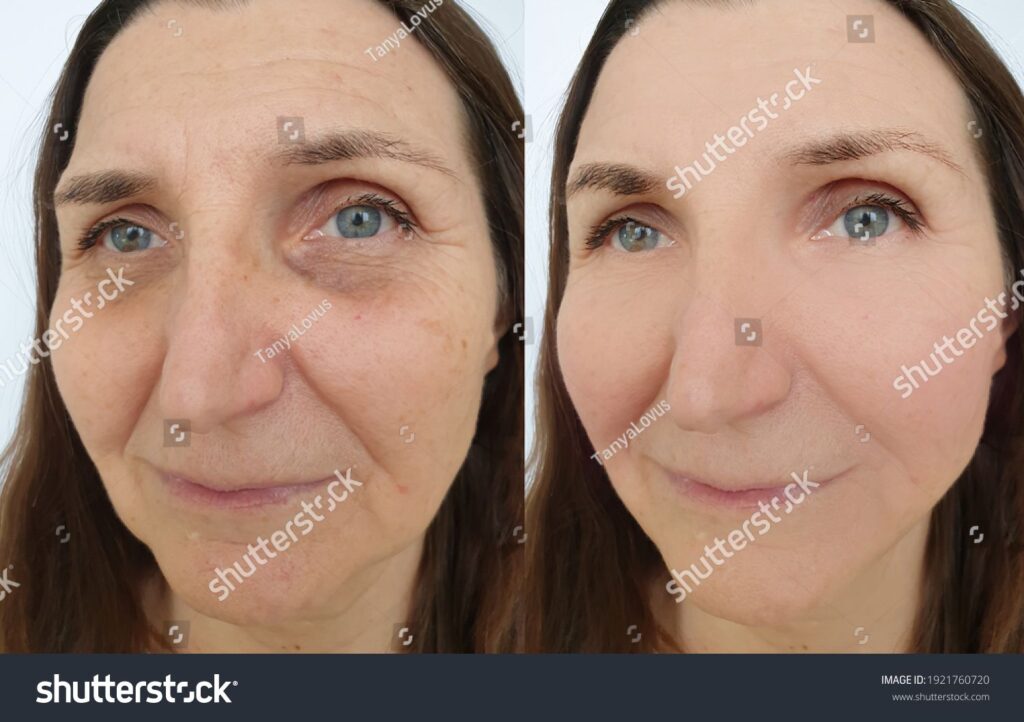 face wrinkles before-and-after-treatment