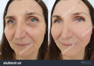 face wrinkles before-and-after-treatment face wrinkles before-and-after-treatment