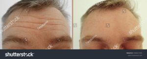 male forehead wrinkle treatment