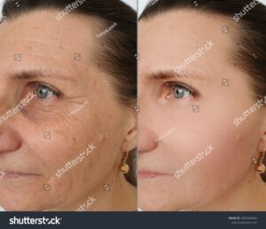 treatment for before and after anti wrinkles