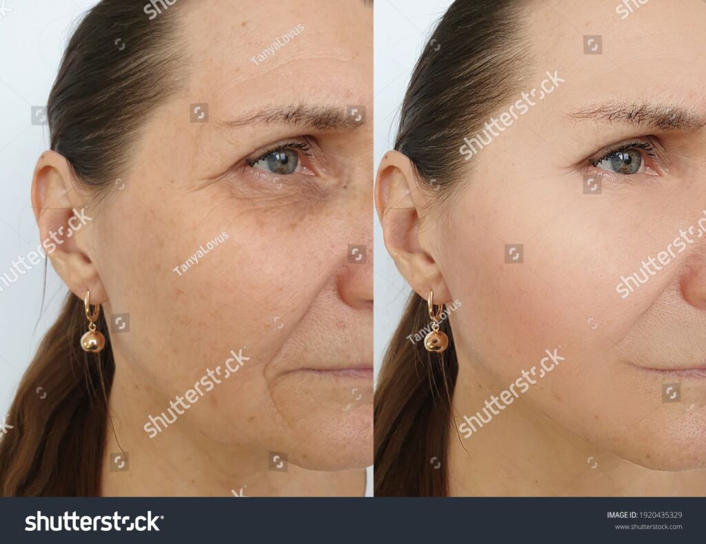 treatment for wrinkles around the eyes