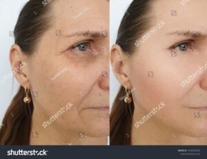treatment for wrinkles around the eyes treatment for wrinkles around the eyes